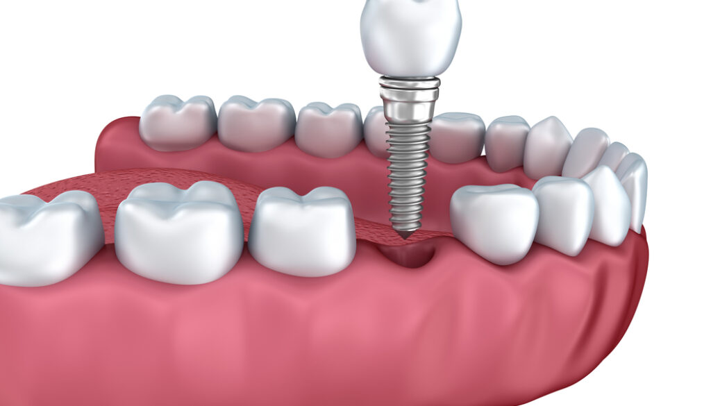 3d lower teeth and dental implant isolated on white
