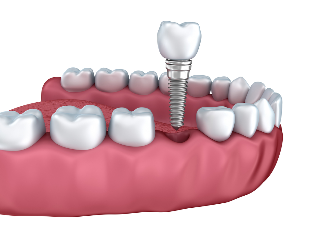 3d lower teeth and dental implant isolated on white