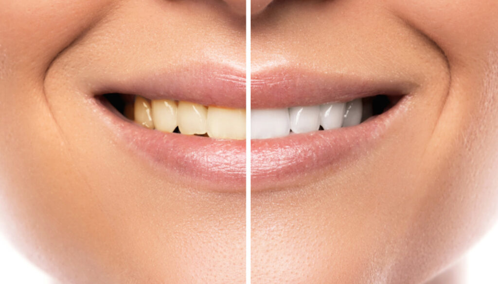 Close up of female mouth. Comparison after teeth whitening