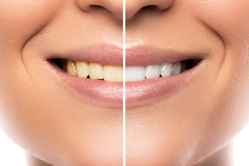 Close up of female mouth. Comparison after teeth whitening